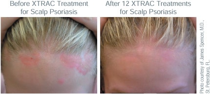 ba xtrac scalp psoriasis tn