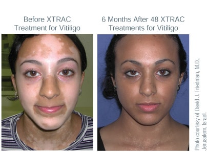 ba xtrac vitiligo adult tn