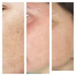 melasma 01