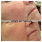 rosacea 01