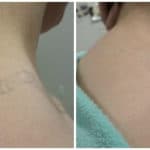 tattoo removal 01