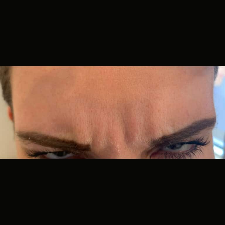 Frown Lines Between Eyebrows Reading Dermatology Frown Lines Between Eyebrows Reading Dermatology